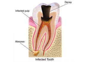 Infected Tooth